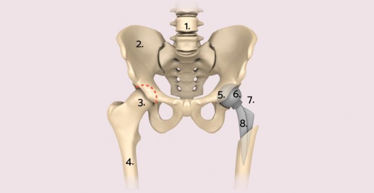 Welche Prothese Als KÜnstliches HÜftgelenk
